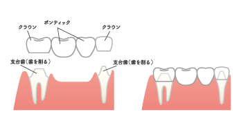 入れ歯イメージ画像