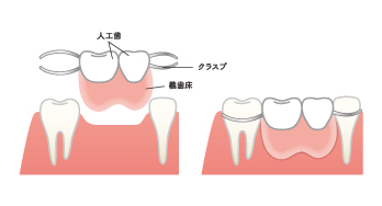 入れ歯イメージ画像