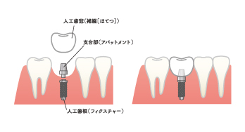 インプラントイメージ画像