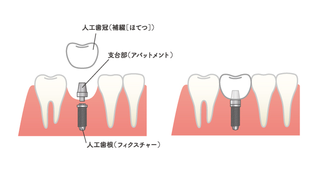 インプラントイメージ画像