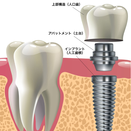 インプラント治療